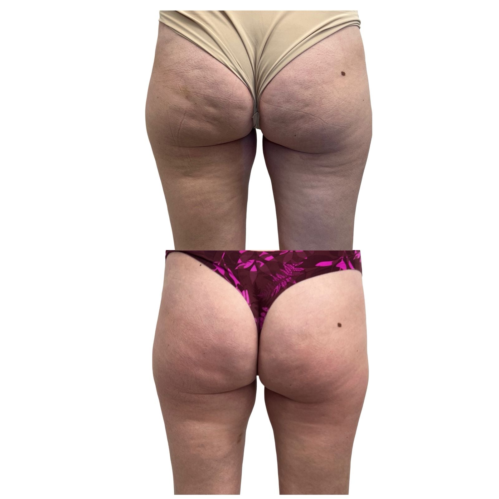 Tratamientos celulitis y flacidez