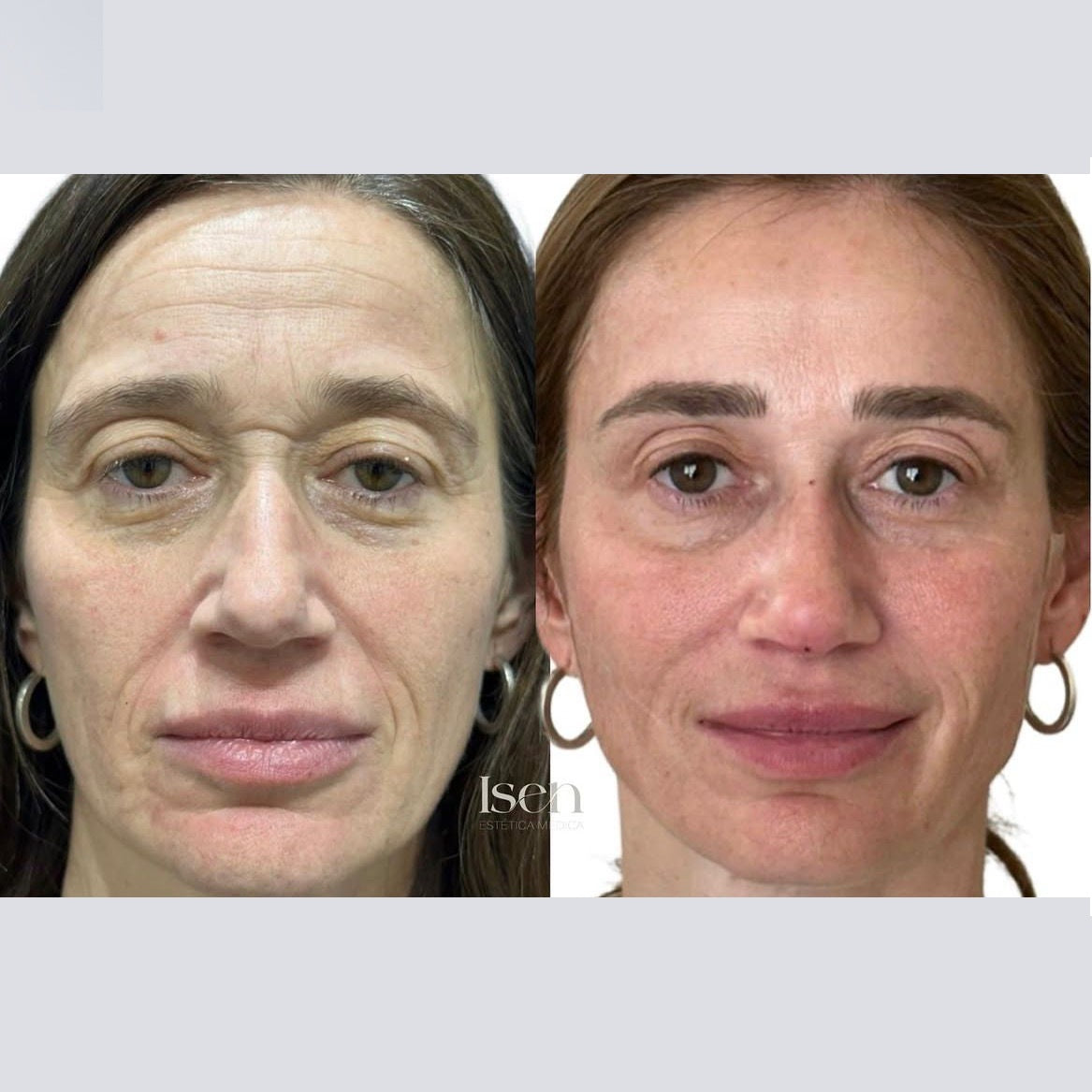 Full face (armonizacion)