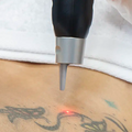 Eliminacion de tatuajes Láser picosecond