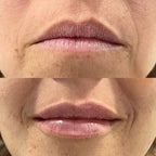 Perfilado labial e inversión de sonrisa