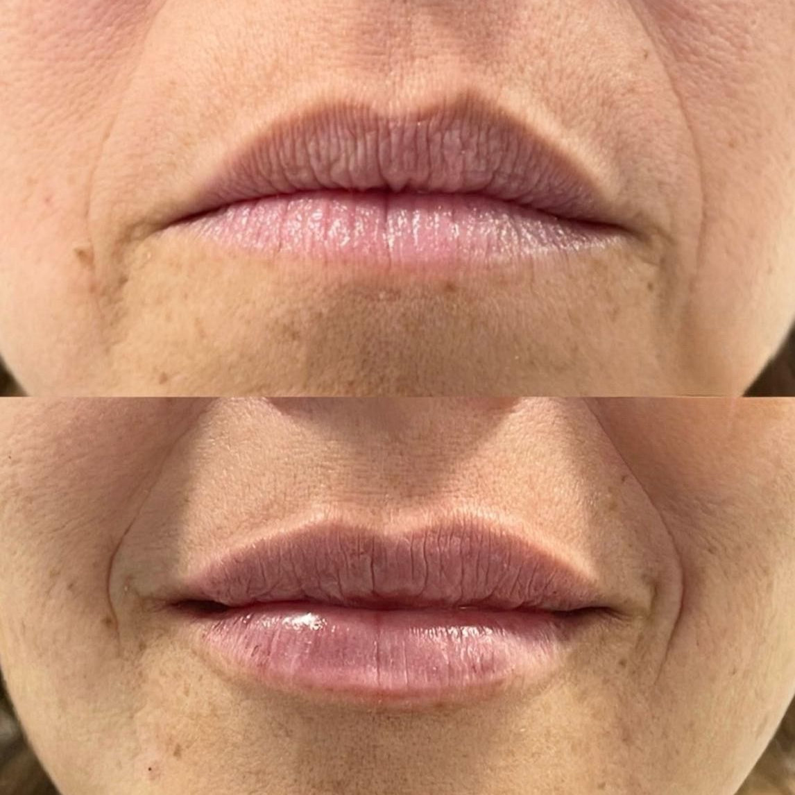 Perfilado labial e inversión de sonrisa