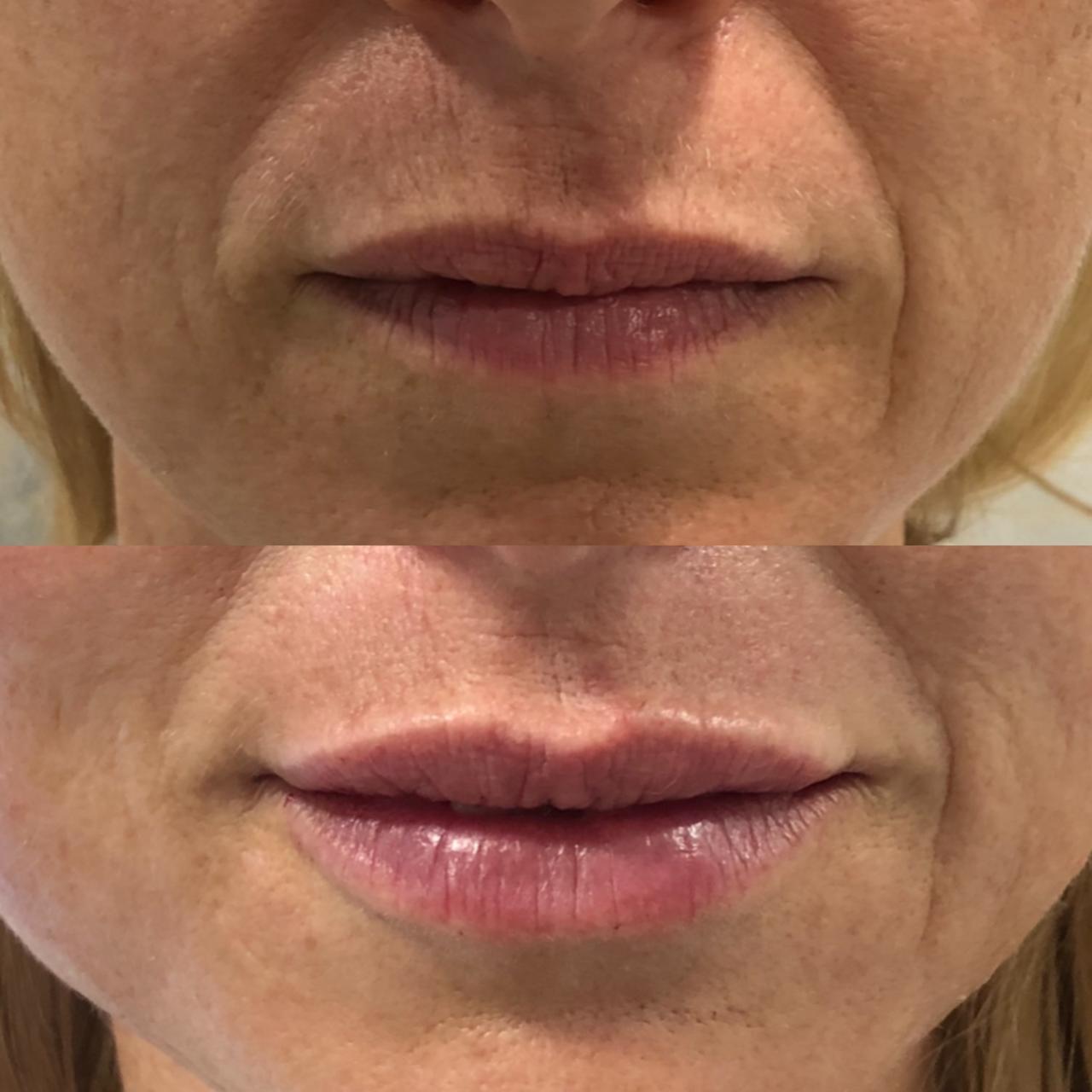 Perfilado + relleno de labios