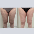 Promociones Corporal: Tratamiento integral Técnica única en Chile (Lipedema)