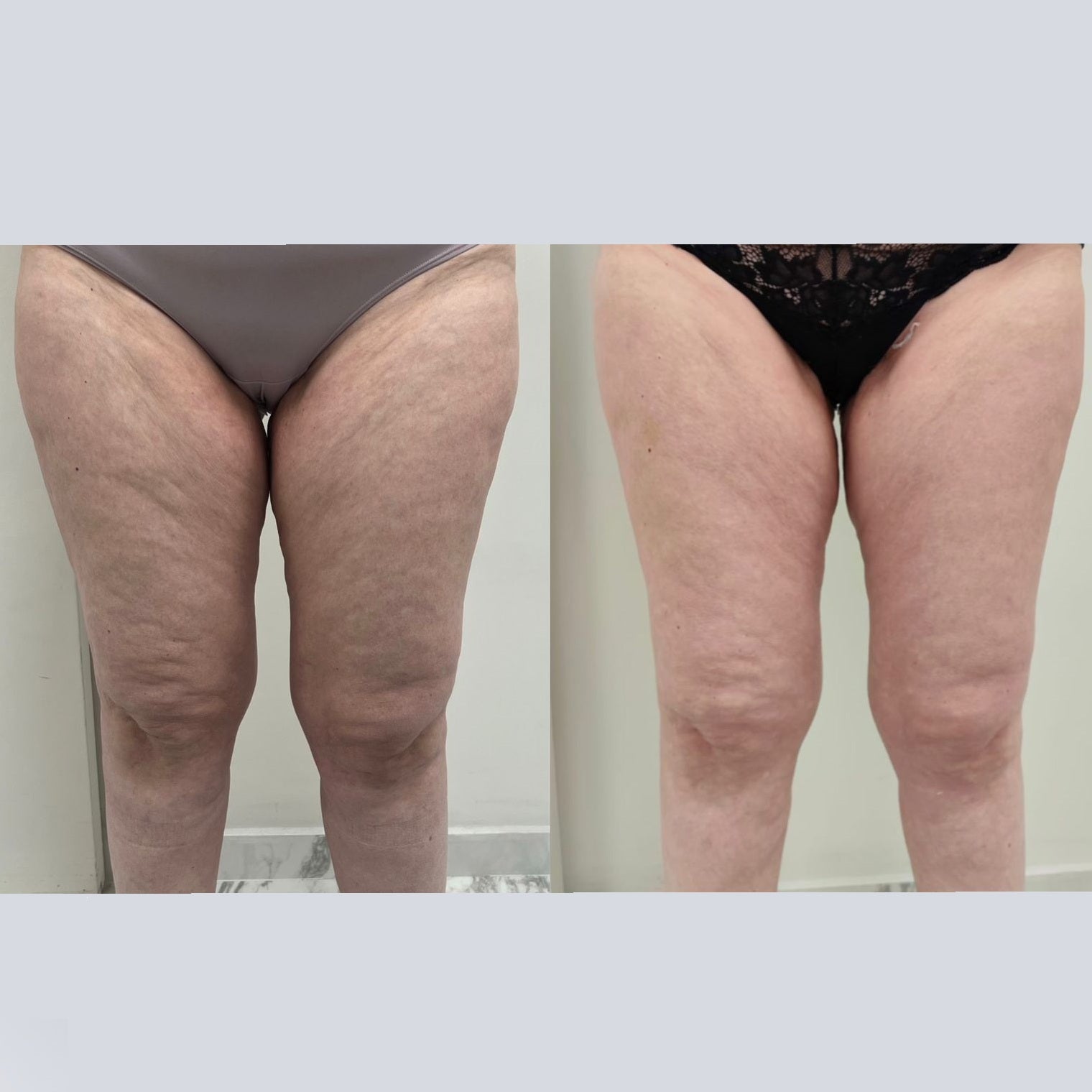 Promociones Corporal: Tratamiento integral Técnica única en Chile (Lipedema)