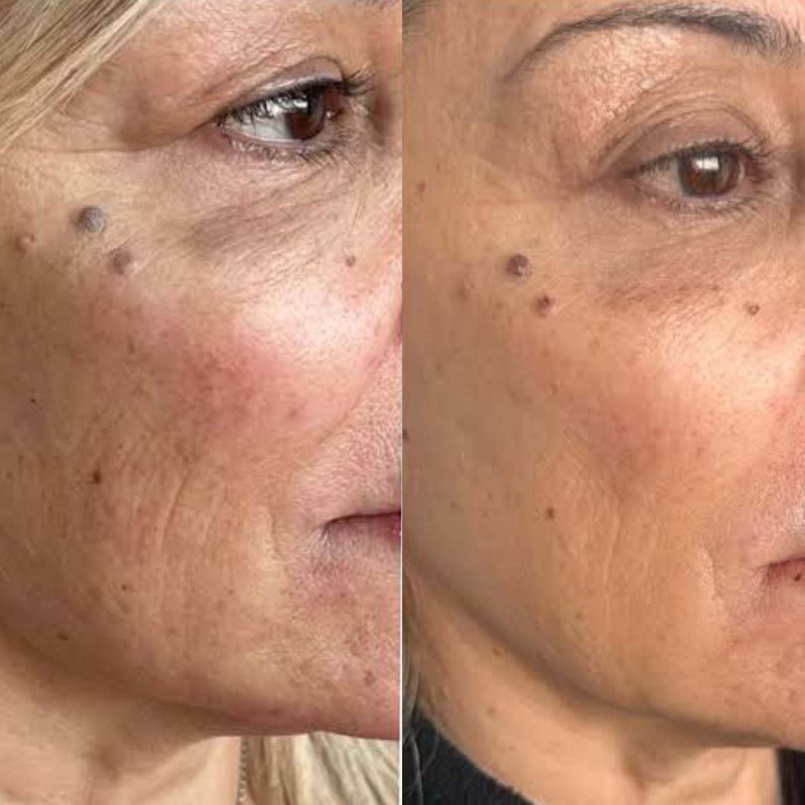 Promociones Facial: Limpieza facial + 3 sesiones Hifu Facial completo