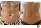 Tratamientos celulitis y flacidez
