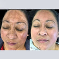 Tratamiento de melasma