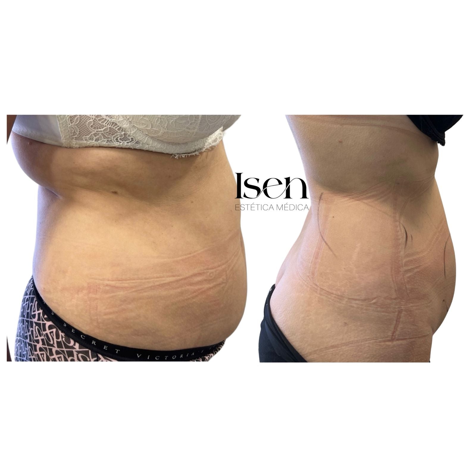 Promociones Corporal: Tratamiento premium integral