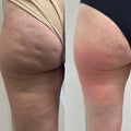 Tratamientos celulitis y flacidez