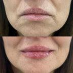 Perfilado labial e inversión de sonrisa