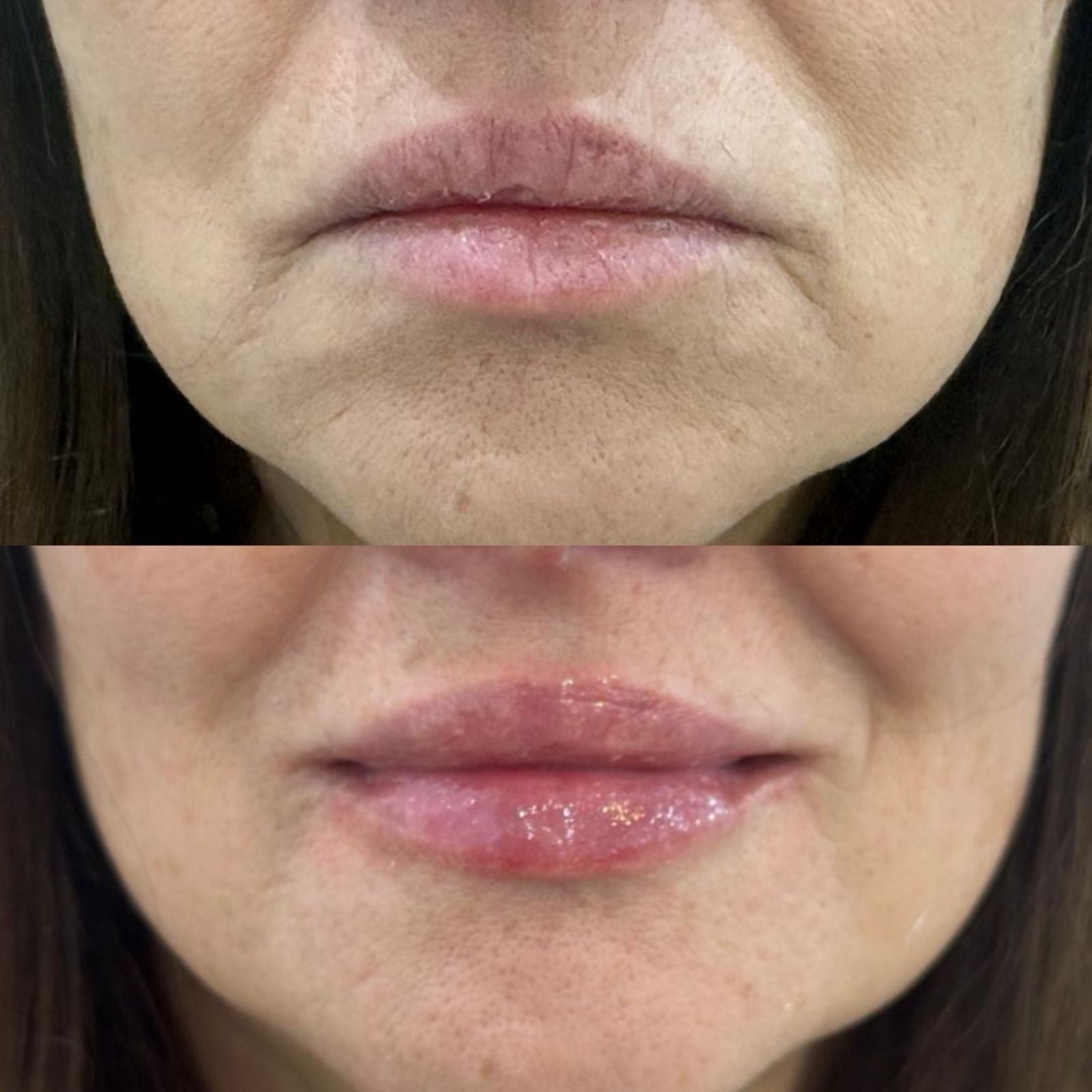 Perfilado labial e inversión de sonrisa